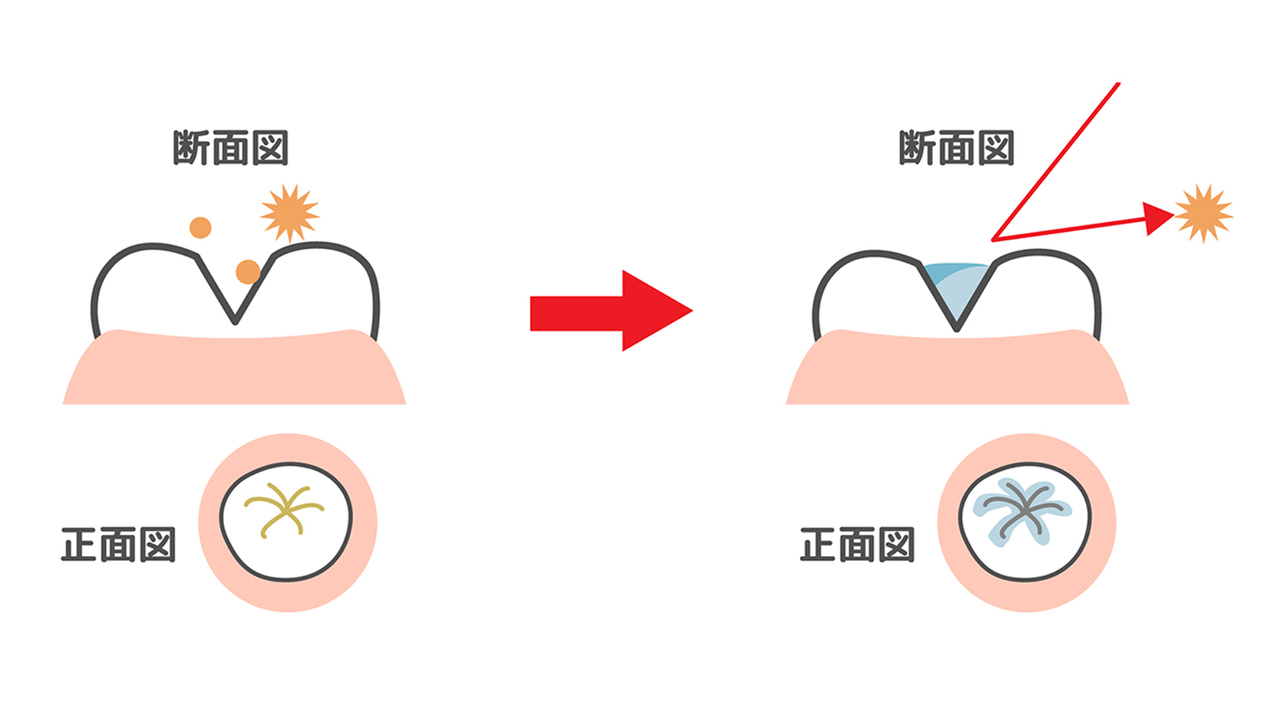 堺市中区・深井駅の5歳のお子さまへの歯科診療内容